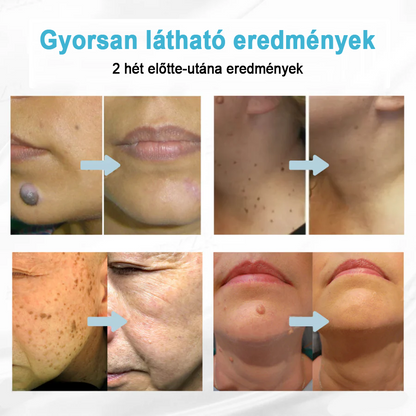 ✨ Bikenda®  – Laserowy Długopis CO₂ do Usuwania 🟤 Znamion, 🦠 Brodawek, 🔘 Przebarwień i Innych Niedoskonałości Skóry）🩹