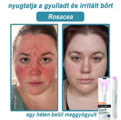 ✨ Bikenda®  – Laserowy Długopis CO₂ do Usuwania 🟤 Znamion, 🦠 Brodawek, 🔘 Przebarwień i Innych Niedoskonałości Skóry）🩹