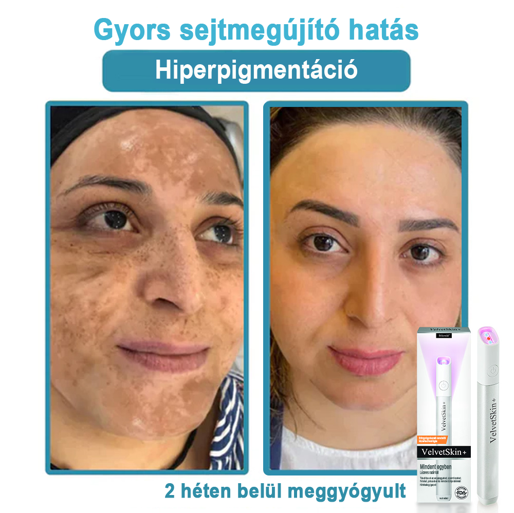✨ Bikenda®  – Laserowy Długopis CO₂ do Usuwania 🟤 Znamion, 🦠 Brodawek, 🔘 Przebarwień i Innych Niedoskonałości Skóry）🩹