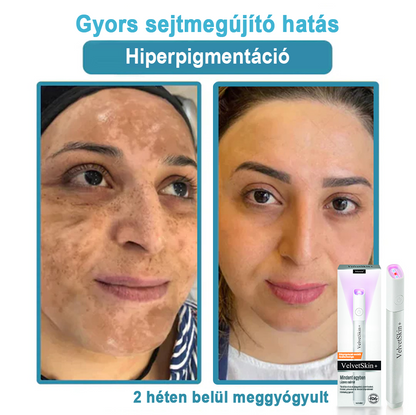 ✨ Bikenda®  – Laserowy Długopis CO₂ do Usuwania 🟤 Znamion, 🦠 Brodawek, 🔘 Przebarwień i Innych Niedoskonałości Skóry）🩹