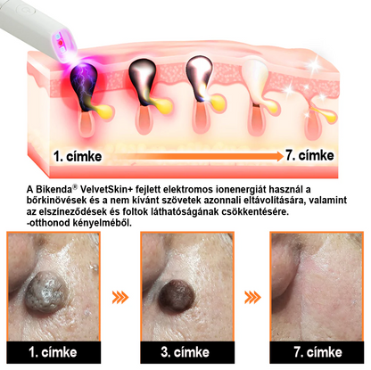 ✨ Bikenda®  – Laserowy Długopis CO₂ do Usuwania 🟤 Znamion, 🦠 Brodawek, 🔘 Przebarwień i Innych Niedoskonałości Skóry）🩹